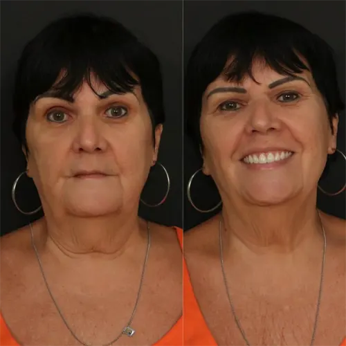 Beige Minimalist Skincare Before and After Instagram Post.png